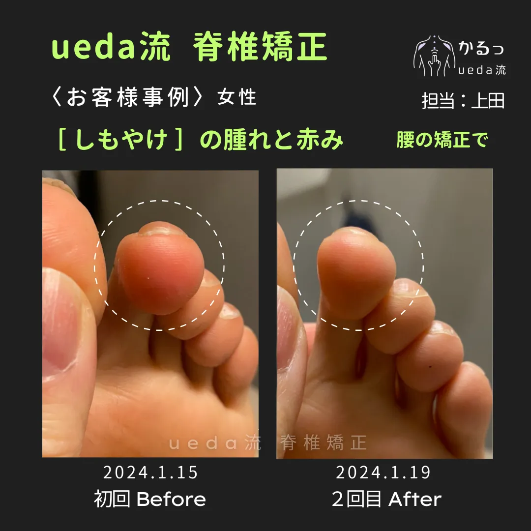 血行不良は 「しもやけ」 にも関係が!?|整体|高砂|播州エリア