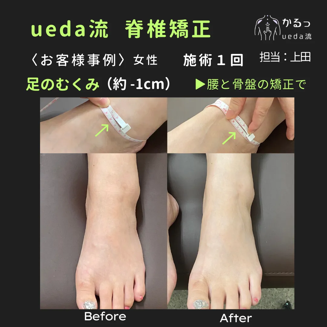 腰と骨盤の矯正で、足のむくみや巻き爪の痛みも?【高砂市|整体】