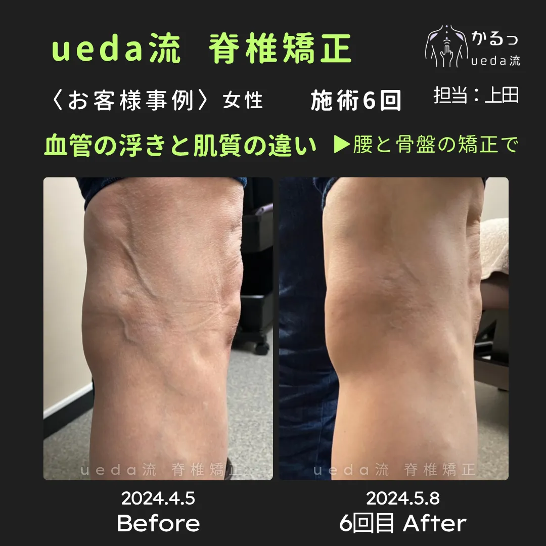 血管の浮きと膝の不調は関係が?|整体|高砂