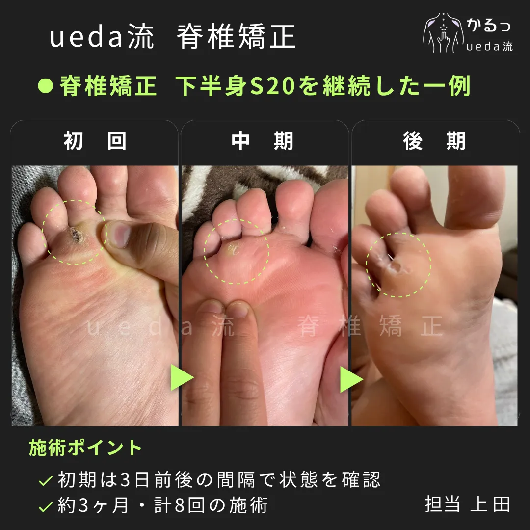 魚の目は腰や足首の状態と関係が?|整体|高砂市